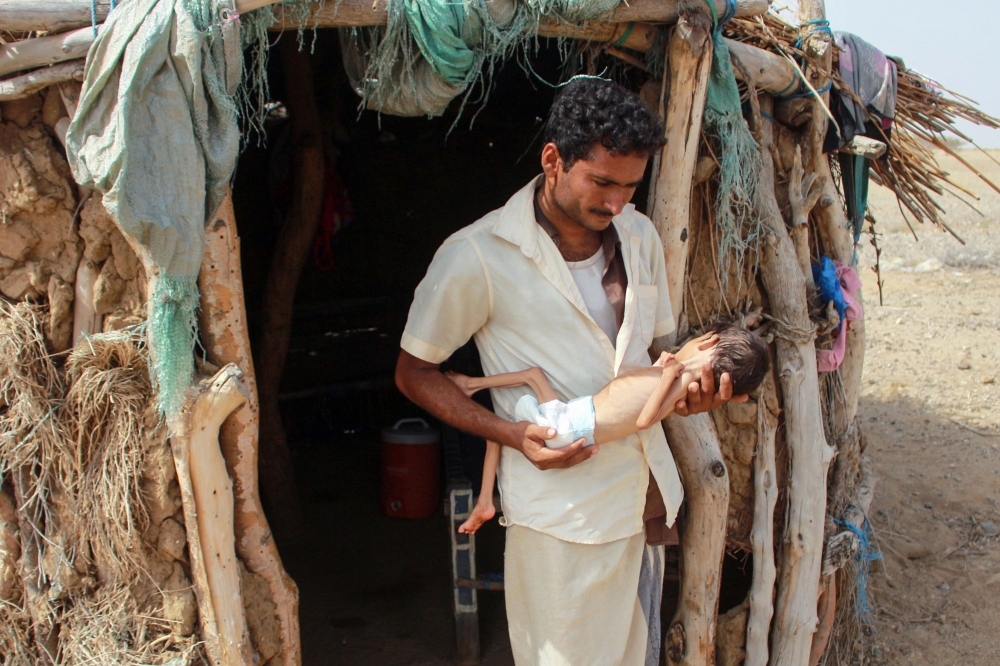 YEMEN-CONFLICT-HEALTH-MALNUTRITION